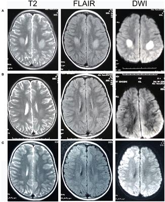 GJB1 Mutation-A Disease Spectrum: Report of Case Series